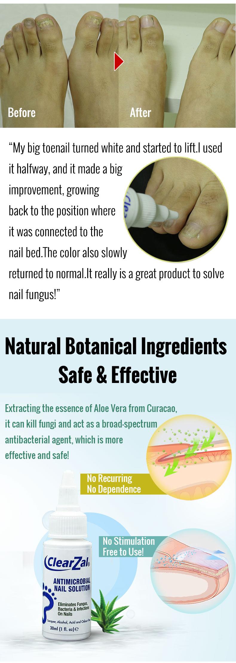 ClearZal Antimicrobial BAC Nail Solution Fungal Nail Treatment 1 Ounce Kills Fungus, Bacteria and  Viruses