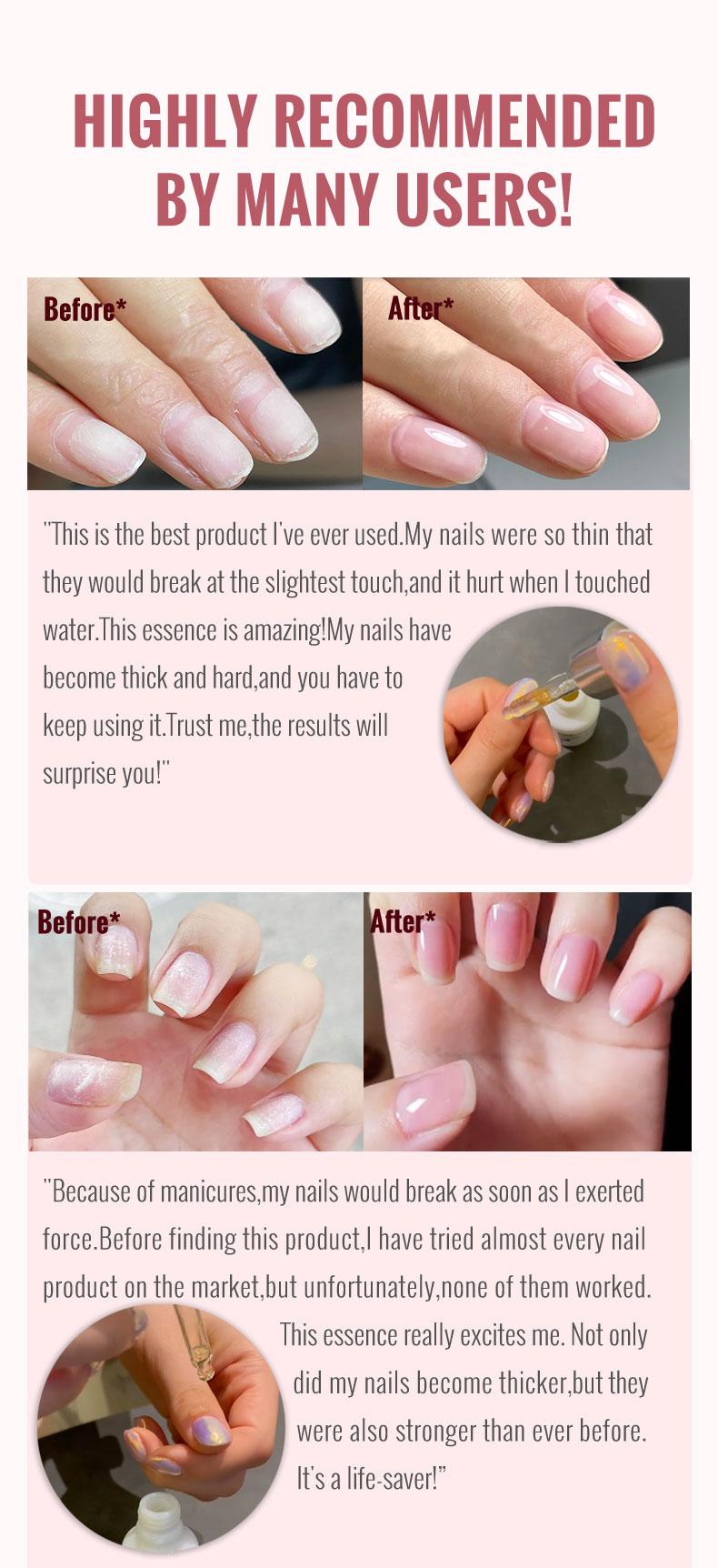 ClearZal Nail and Cuticle Serum, Hydrates Conditions Repairs - 1 oz Nail Nutrition Repair damaged nails  For Weak, Thin, Soft, Peeling Nails, Enriched with Tea Tree Oil, Vitamin E,  Avocado Oil,Reinforces, Thickens Nails, Promotes Strength and Flexibilit