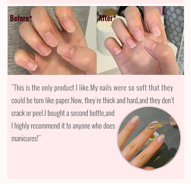 ClearZal Nail and Cuticle Serum, Hydrates Conditions Repairs - 1 oz Nail Nutrition Repair damaged nails  For Weak, Thin, Soft, Peeling Nails, Enriched with Tea Tree Oil, Vitamin E,  Avocado Oil,Reinforces, Thickens Nails, Promotes Strength and Flexibilit