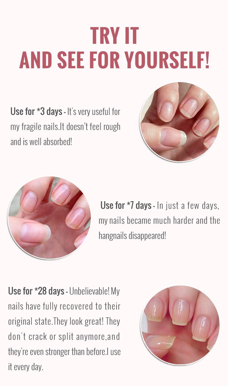 ClearZal Nail and Cuticle Serum, Hydrates Conditions Repairs - 1 oz Nail Nutrition Repair damaged nails  For Weak, Thin, Soft, Peeling Nails, Enriched with Tea Tree Oil, Vitamin E,  Avocado Oil,Reinforces, Thickens Nails, Promotes Strength and Flexibilit