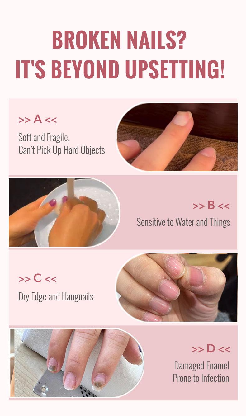 ClearZal Nail and Cuticle Serum, Hydrates Conditions Repairs - 1 oz Nail Nutrition Repair damaged nails  For Weak, Thin, Soft, Peeling Nails, Enriched with Tea Tree Oil, Vitamin E,  Avocado Oil,Reinforces, Thickens Nails, Promotes Strength and Flexibilit
